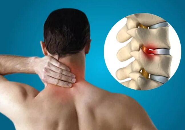 Osteocondrose cervical