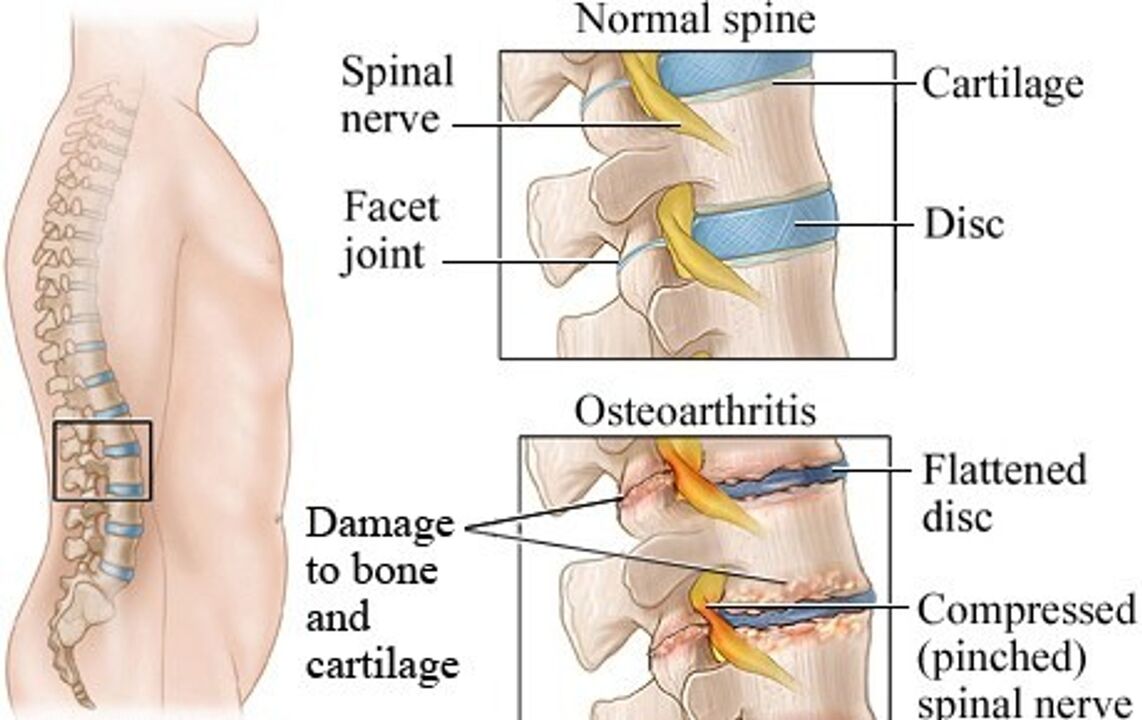 A diferenza entre un disco saudable e un disco con osteocondrose