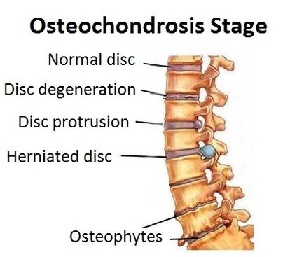 Etapas da osteocondrose
