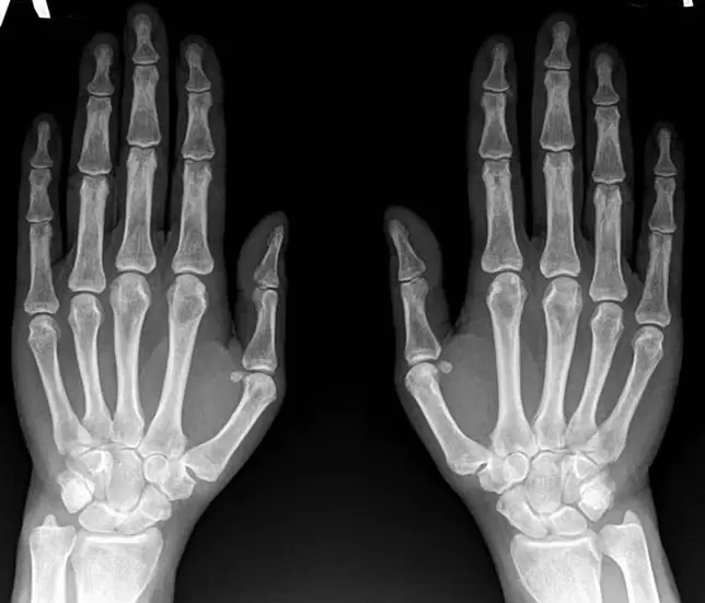 artrite da articulación do pulso na radiografía antes de usar Hondroine